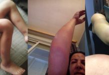 Los malos olores y las picaduras amargan el verano al barrio de Butarque